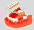 Implantes dentales en Las Palmas