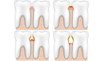 Implantes dentales en Las Palmas